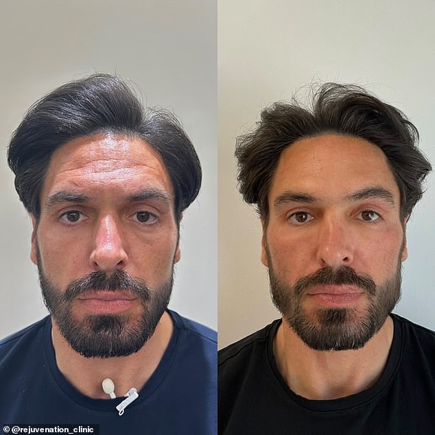 Mario Falcone embraces a total skincare transformation in Essex as the former TOWIE star undergoes fillers, Botox, and salmon sperm facials to stay the hottest dad at the school gates